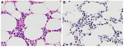 Chronic Active Epstein–Barr Virus Disease